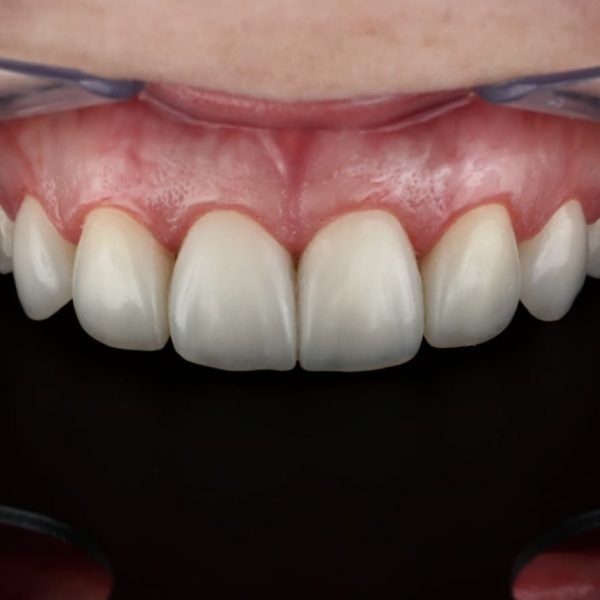 Sorriso transformado Odontologia Autoral